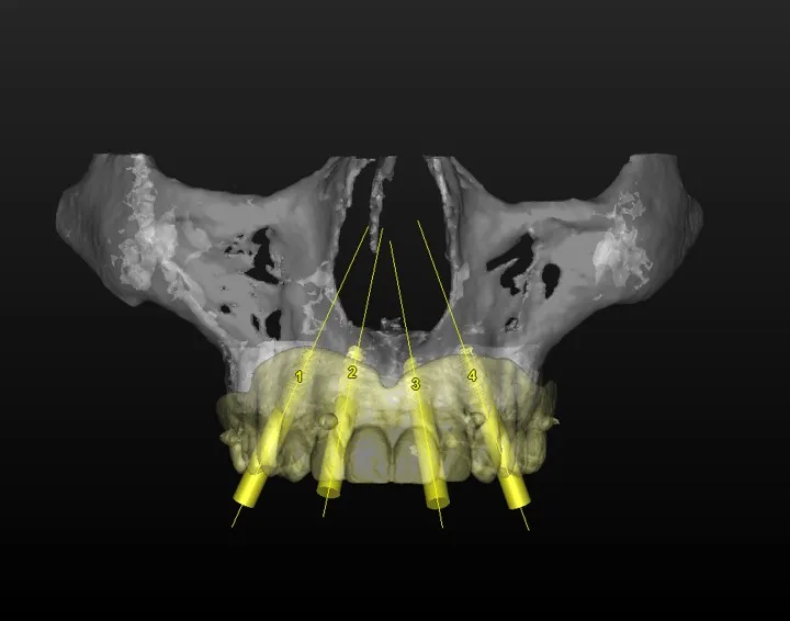 Placements of implants
