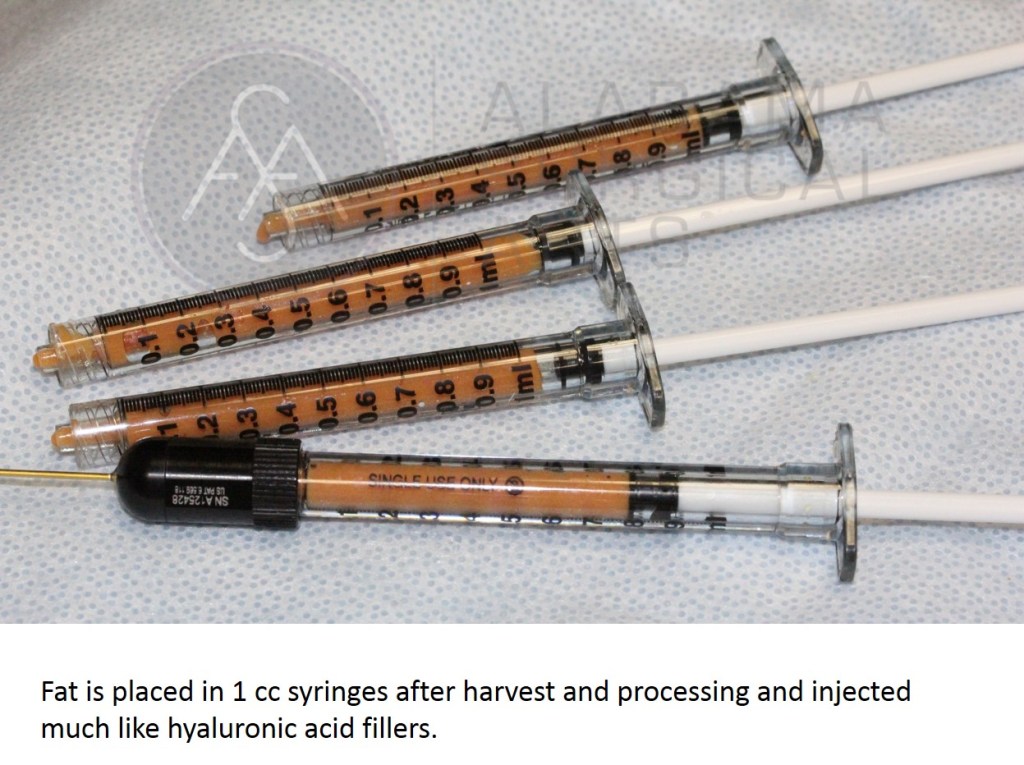 Fat Transfer Montgomery AL | Fat Injections | Alabama Surgical Arts