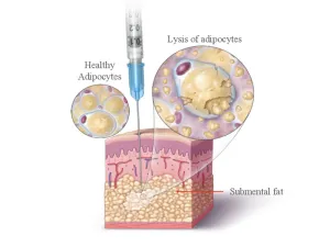 Kybella