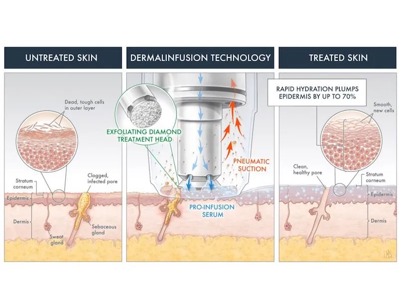 dermal Infusion Facial