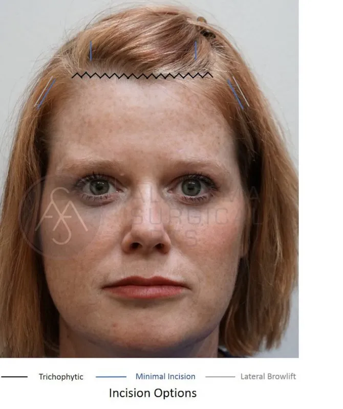 After Upper Blepharoplasty