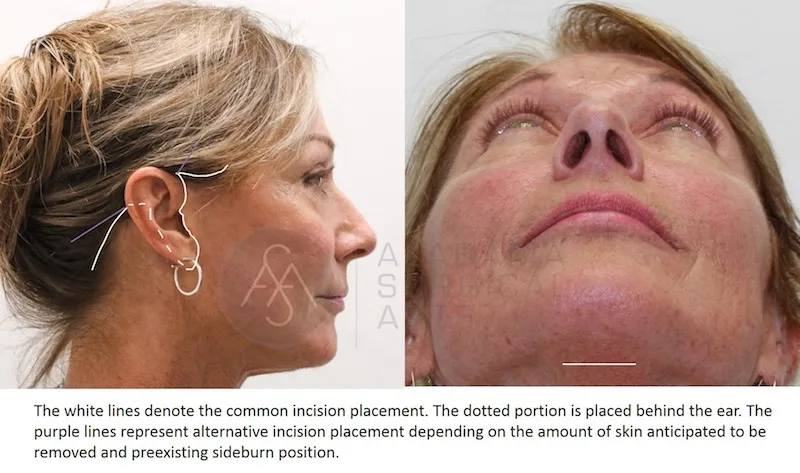 Before And After Facelife