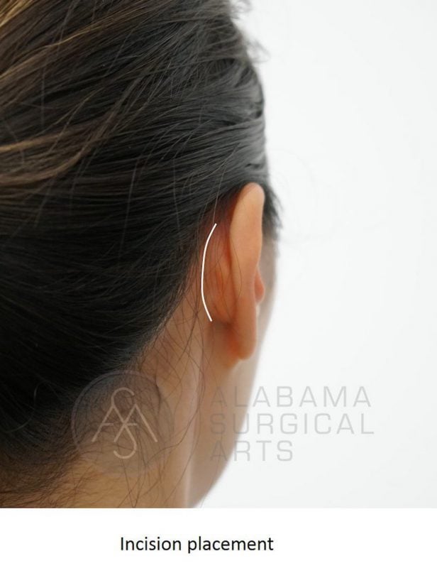 Otoplasty