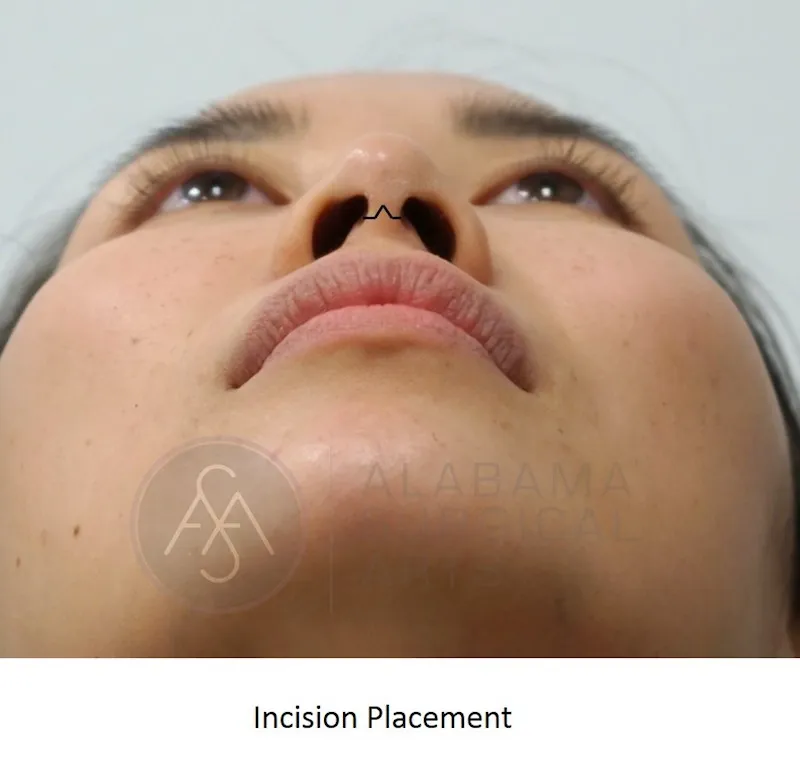 Before And After Nose Job