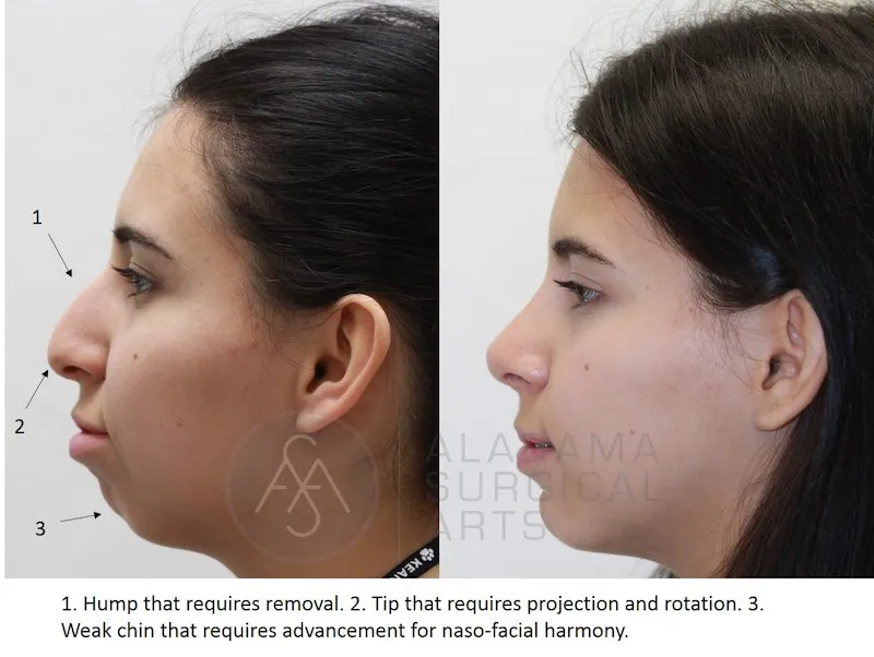 Before And After Nose Job