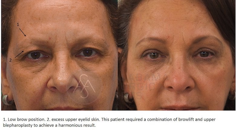 Before and After Blepharoplasty