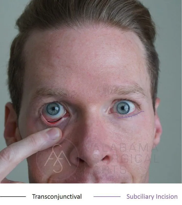 After Lower Blepharoplasty