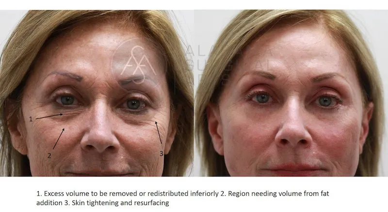 Before And After Blepharoplasty