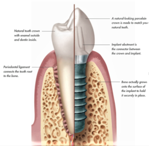 Information on different parts of a dental implant
