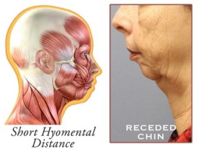 Skeletal Deficiency