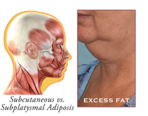 excess fat diagram for neck lift