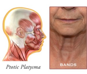 Bands diagram for neck lift