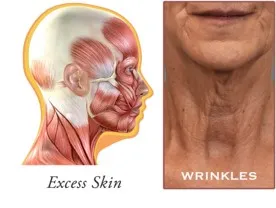 Loose skin diagram for neck lift