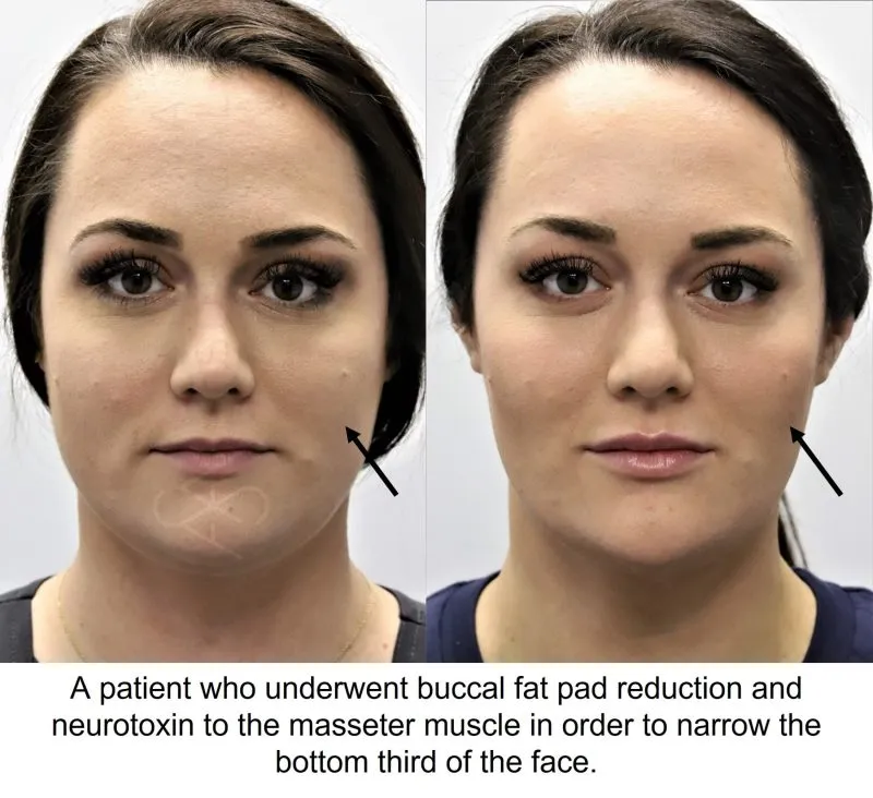 buccal fat pad