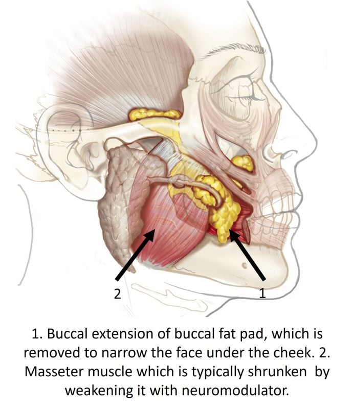 buccal fat pad
