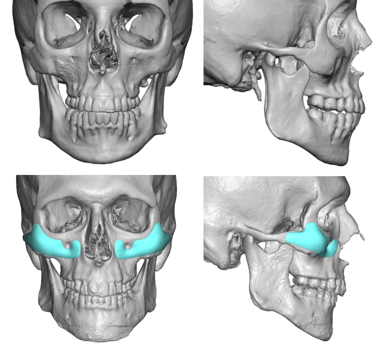 custom facial implants