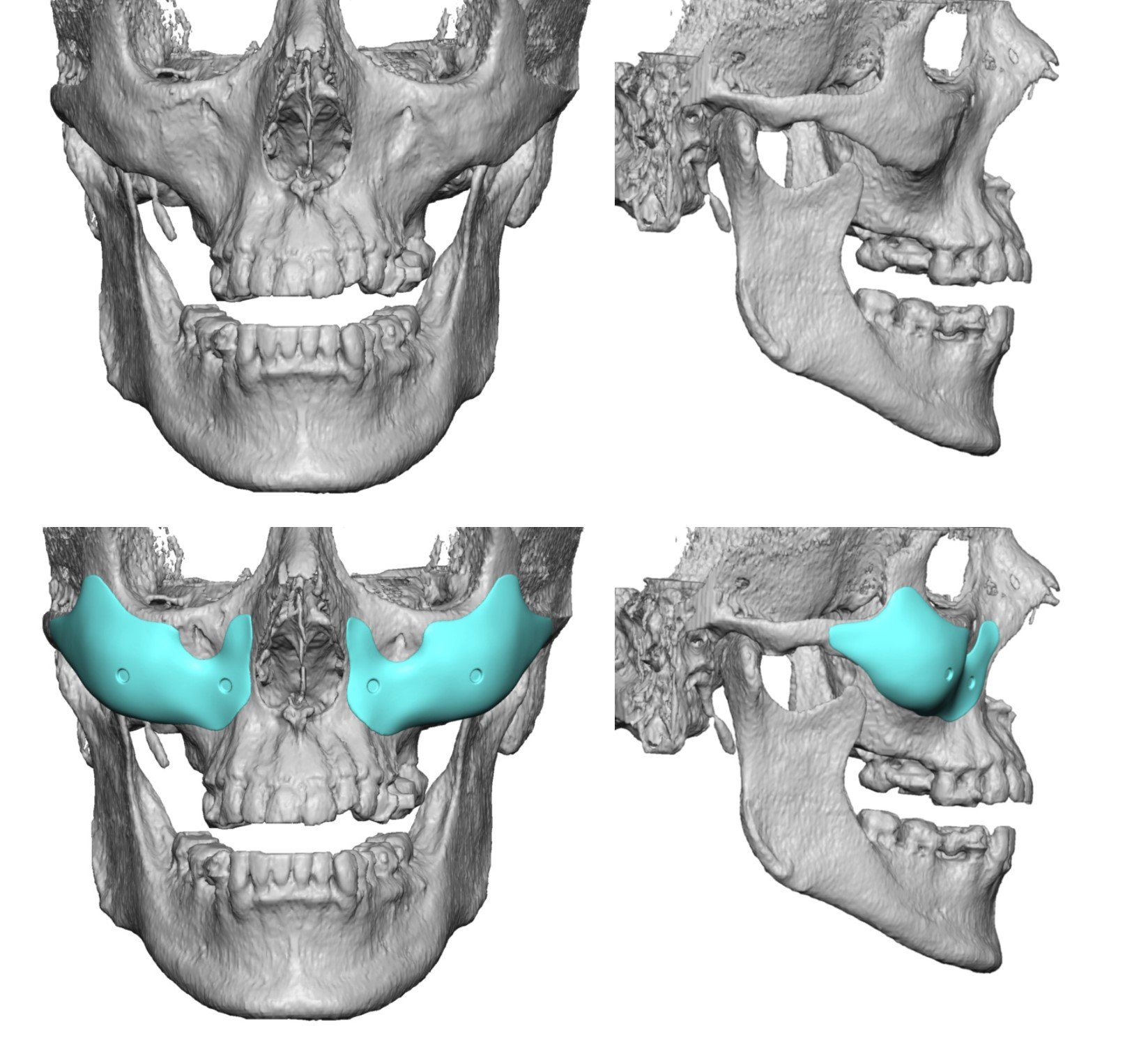 custom facial malar implants