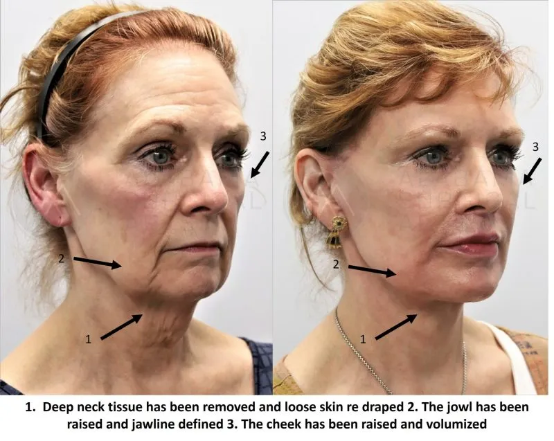 deep plane face lift
