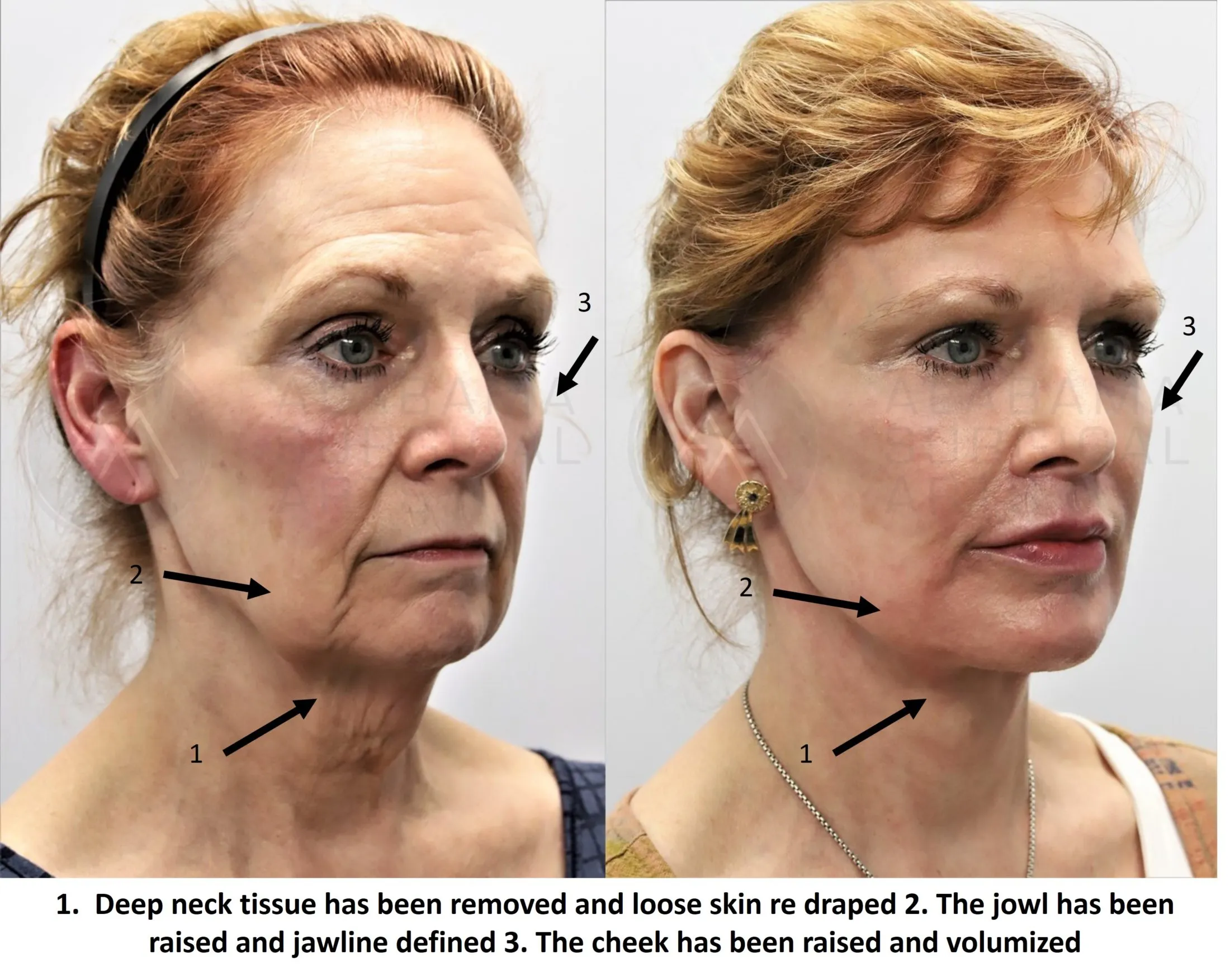Facelift Montgomery, Lower Face & Neck Lift