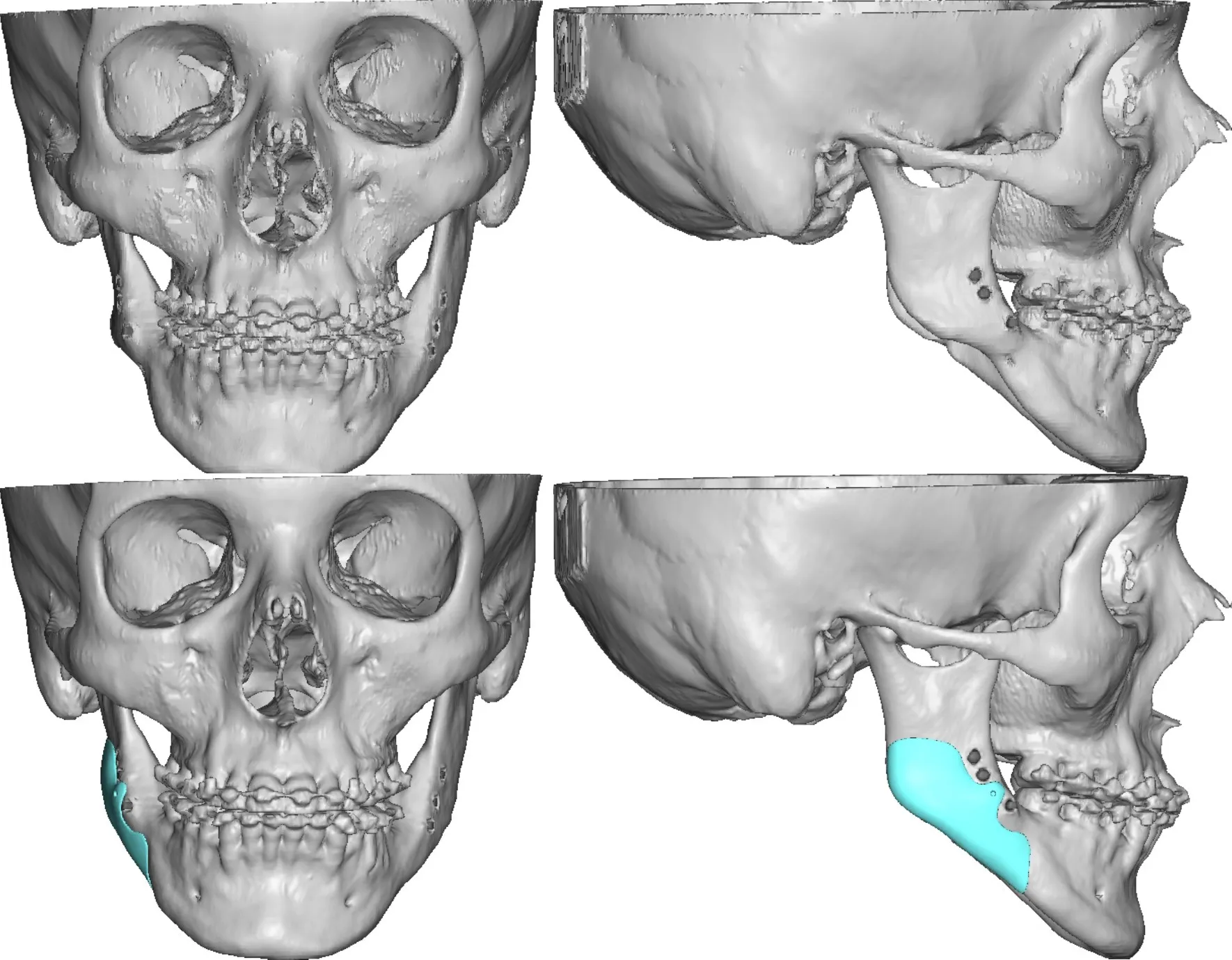 custom mandible implant