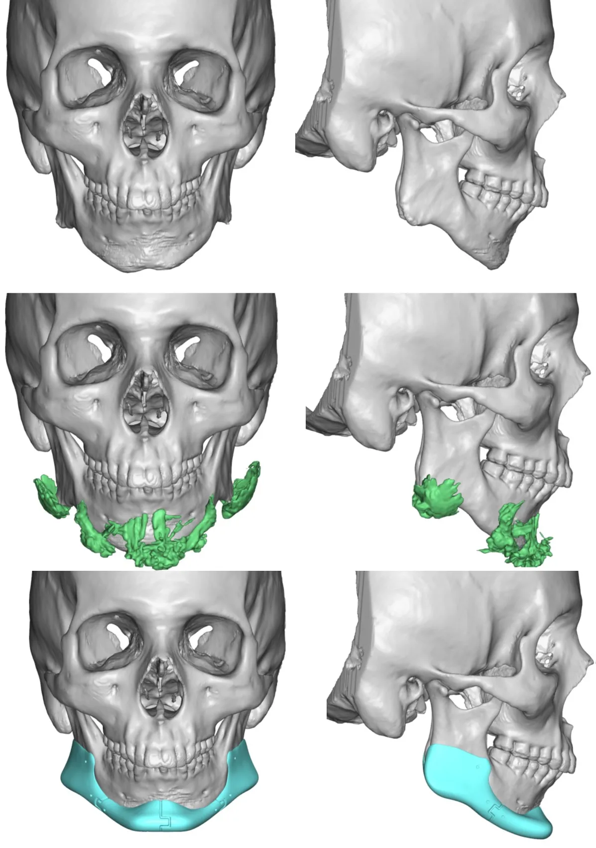 custom jawline implant