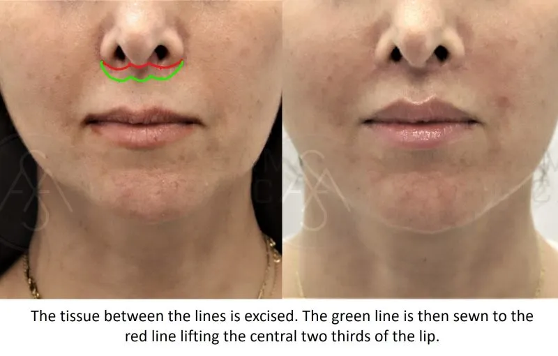 before and after lip lift