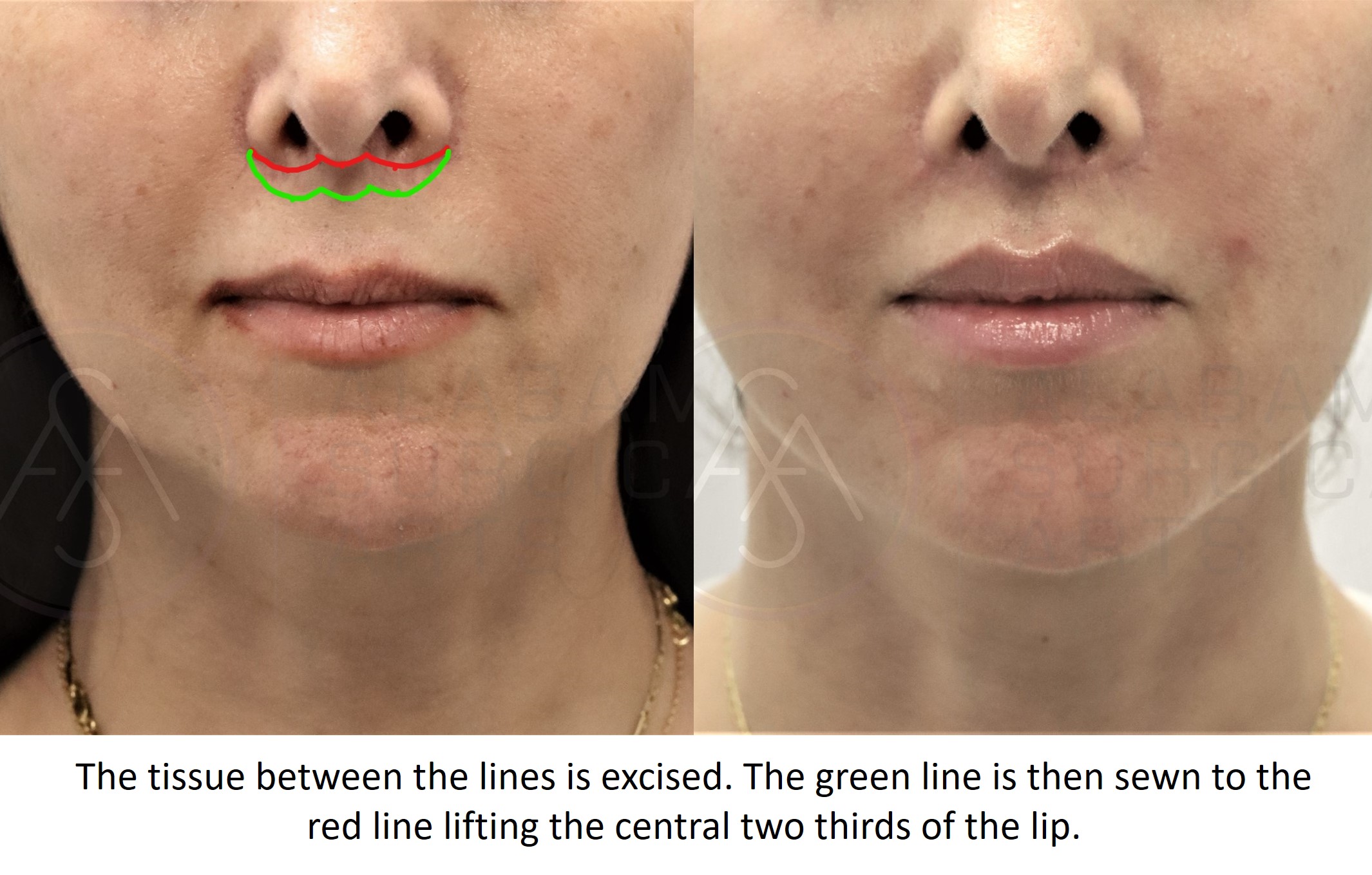 Lip Lift Montgomery AL Bullhorn Lip Lift Alabama Surgical Arts