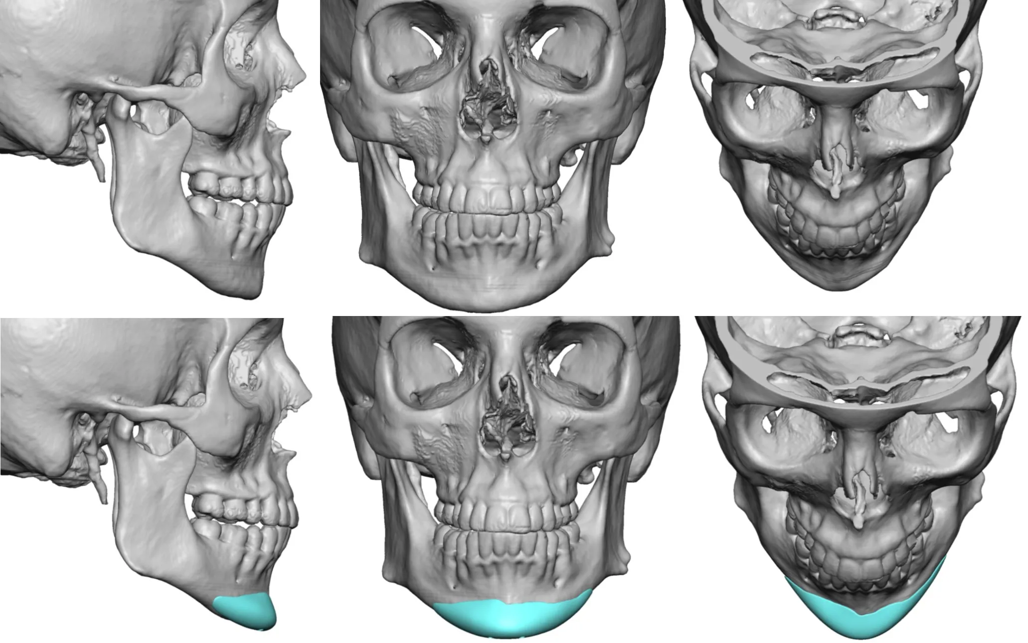 custom chin implant