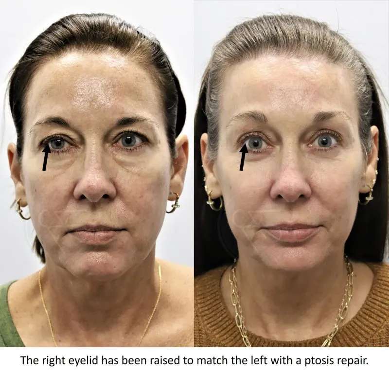 Upper eyelid ptosis repair