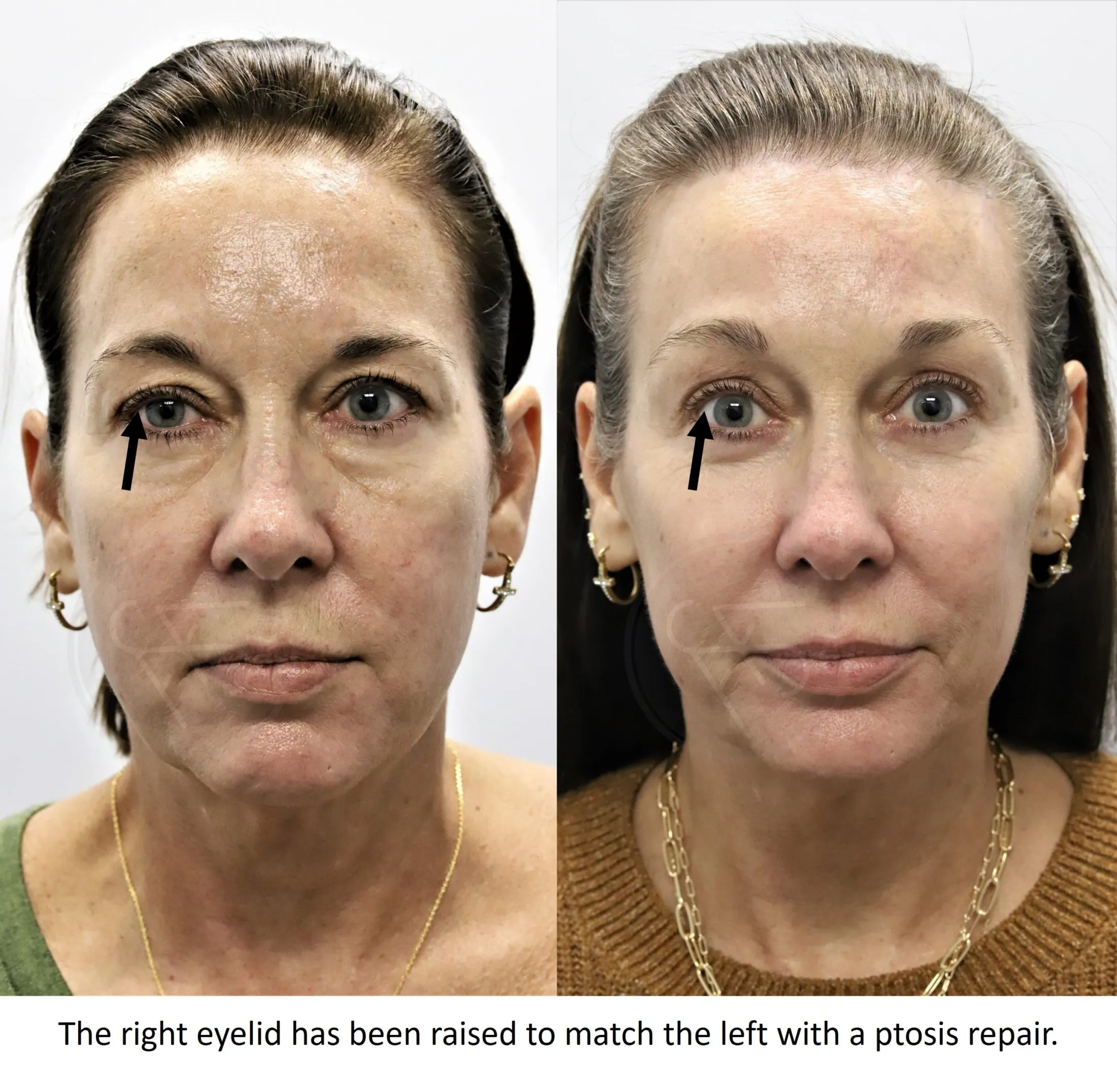 Upper eyelid ptosis repair