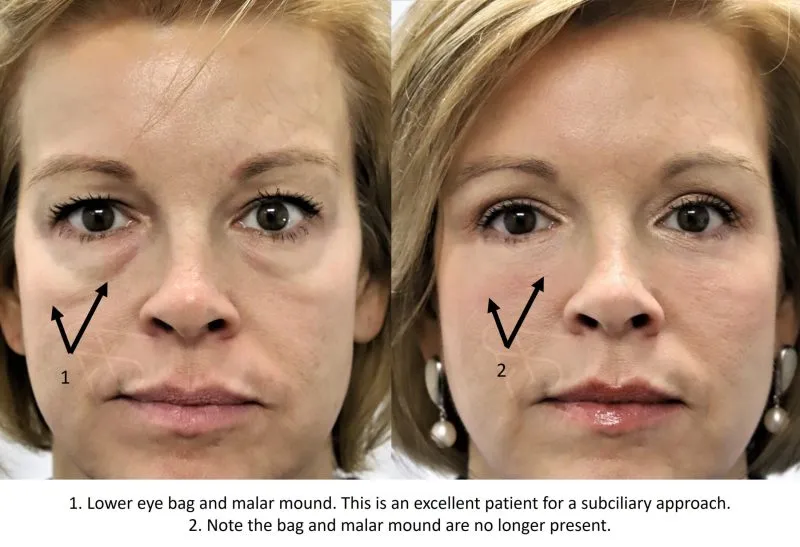 lower eyelid surgery