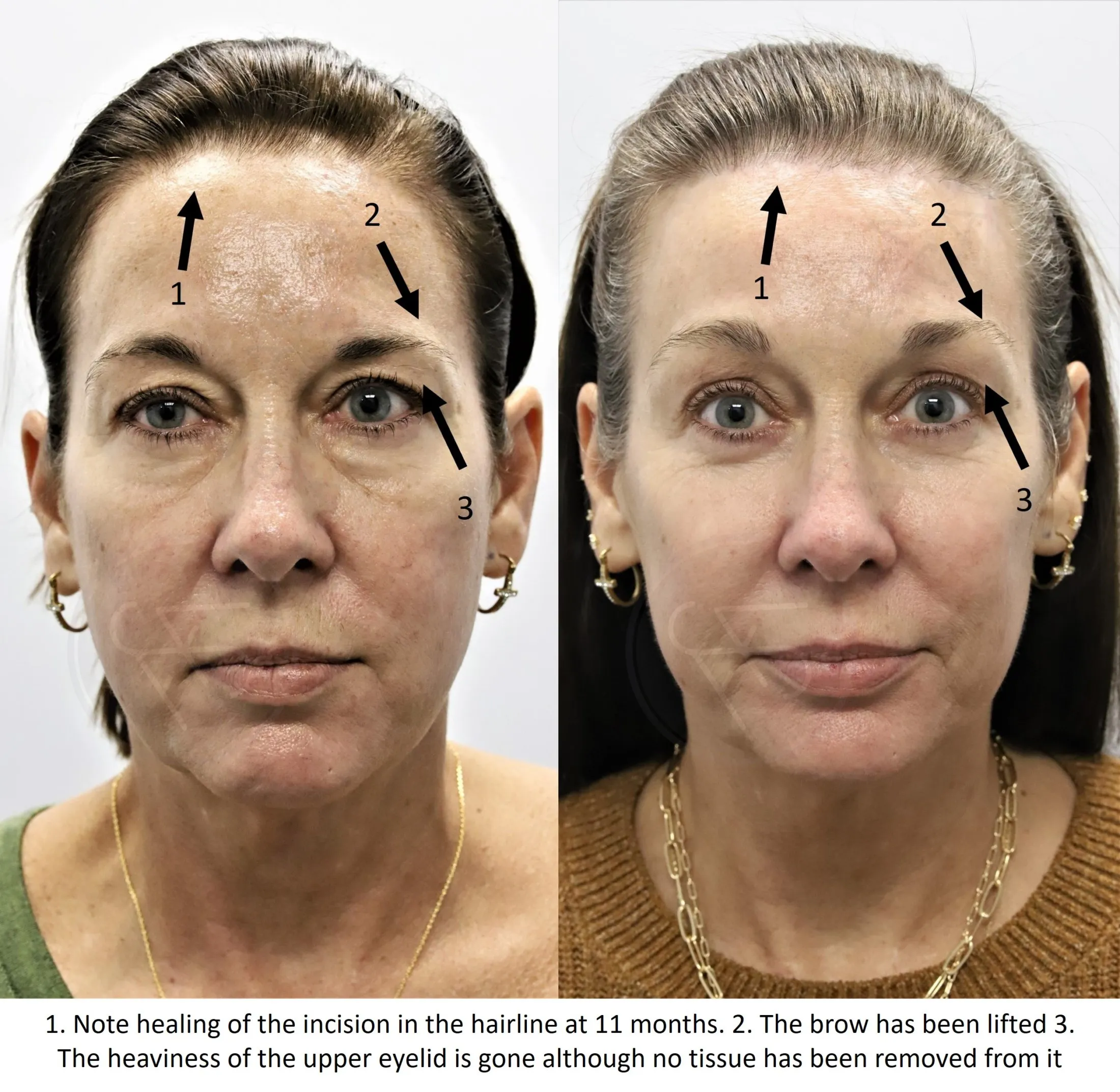 brow lift