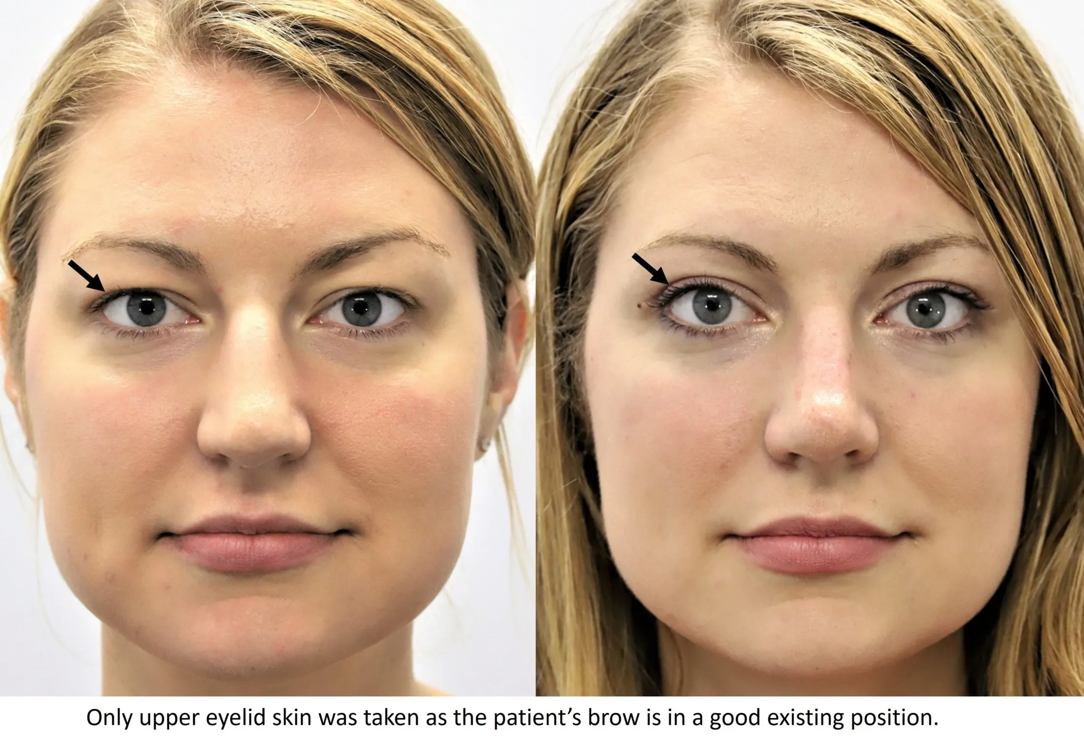 upper blepharoplasty