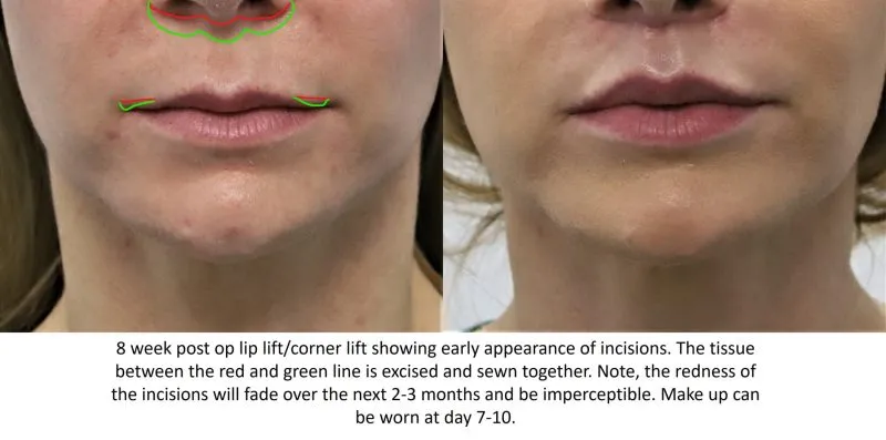 before and after lip lift