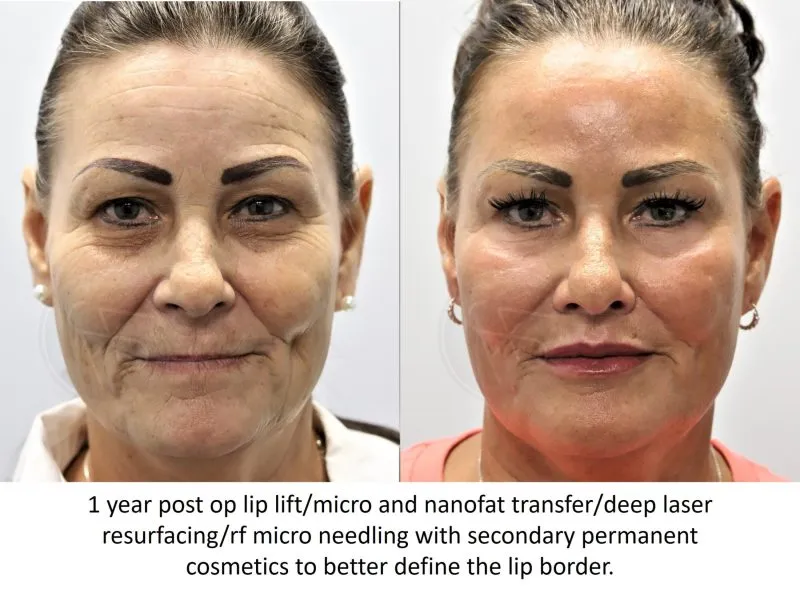 before and after lip lift