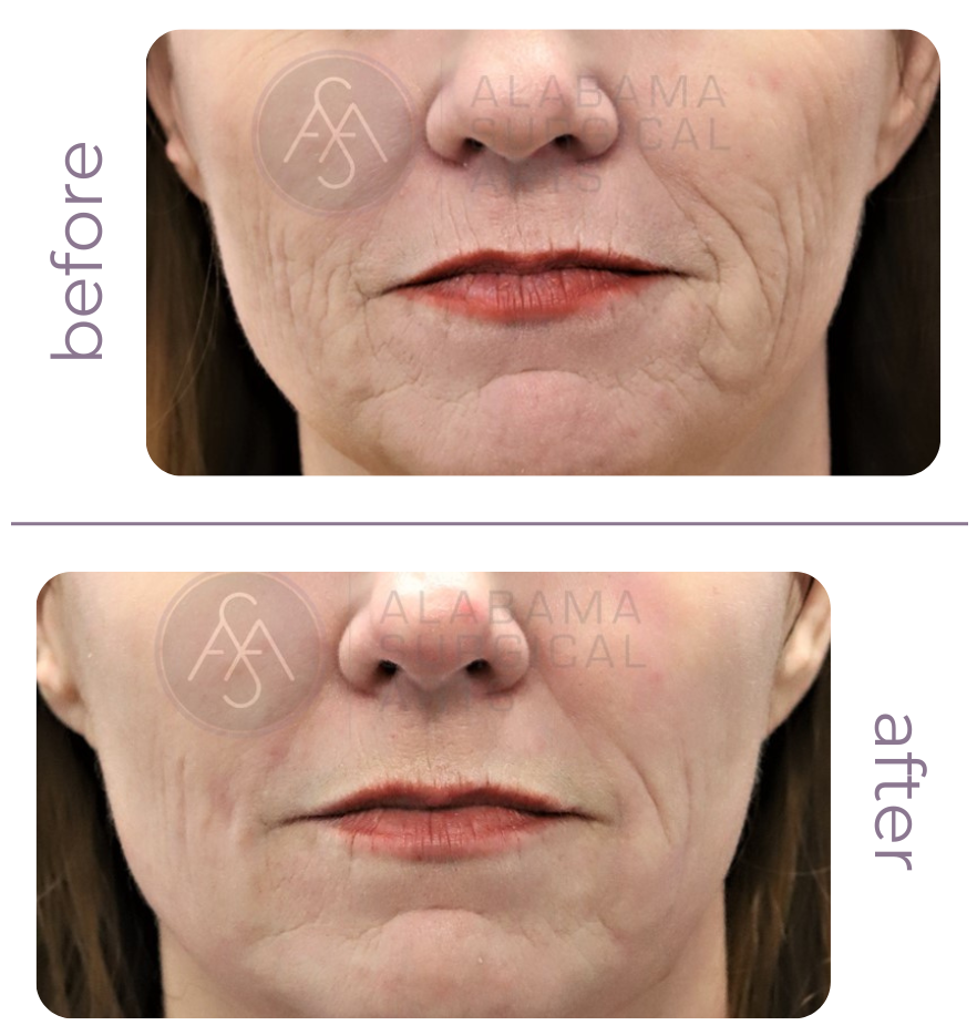 Alabama Surgical Arts Laser Skin Resurfacing Before and After