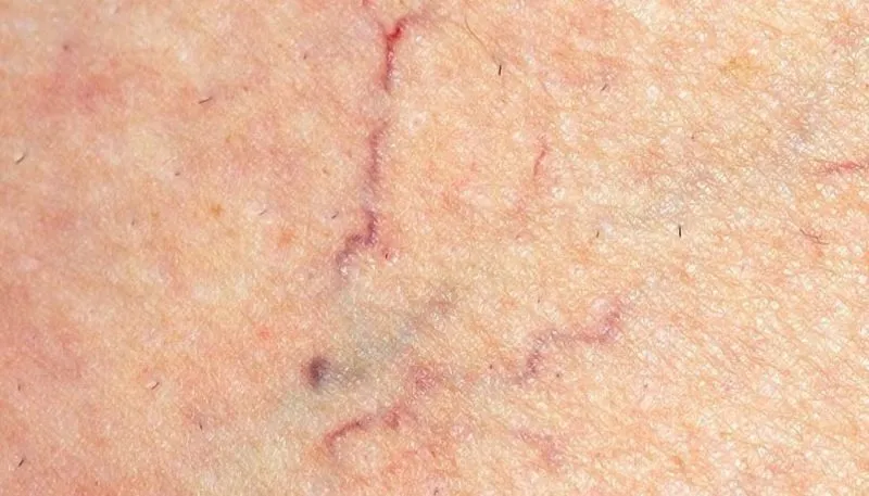 Spider veins