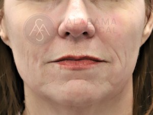 laser resurfacing after front