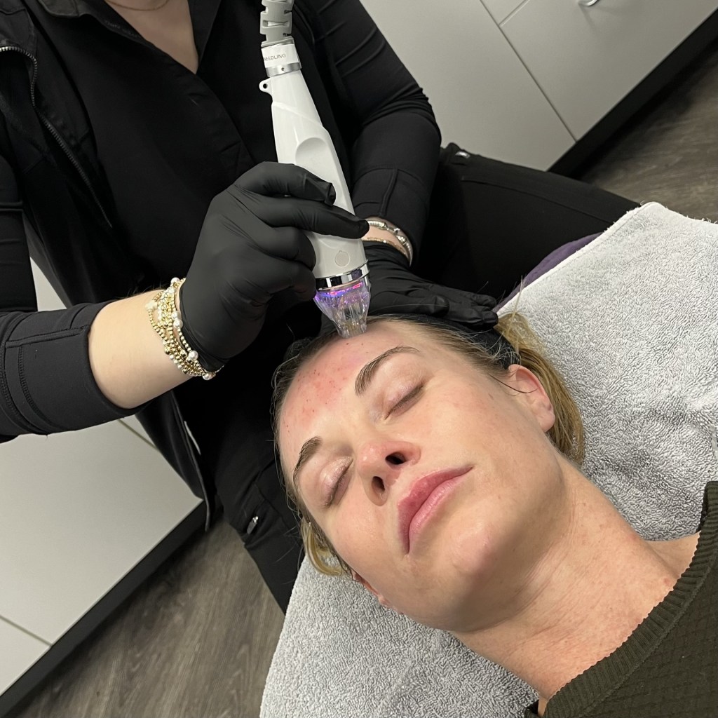 rf microneedling